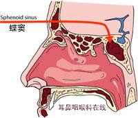 蝶窦炎